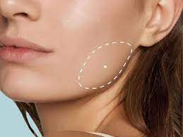 Masseter Botox